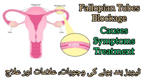 Fallopian Tubes Blockage Causes Symptoms And Treatment In Urdu Hindi Block Tubes Ka Ilaj