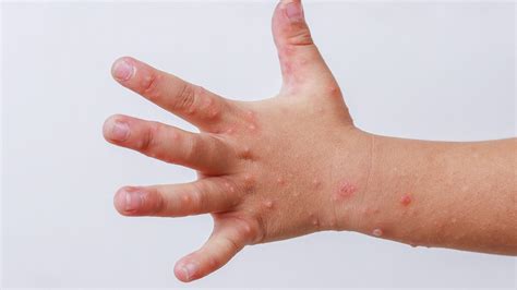 Hand Foot And Mouth Disease An Overview 42 Off