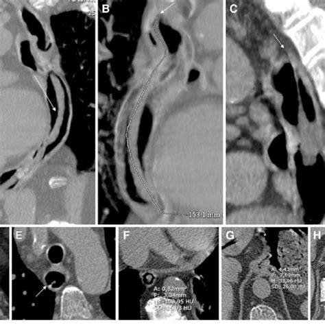 Pdf Giant Fibrovascular Polyp Of The Esophagus Imaging Techniques For Proper Treatment