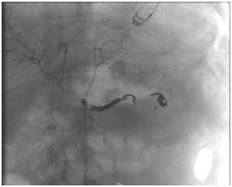 Jcm Free Full Text Endovascular And Open Surgical Treatment Of Ruptured Splenic Artery