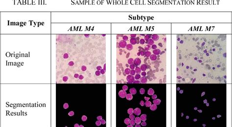 Figure 2 From Classification Of Cell Types In Acute Myeloid Leukemia Aml Of M4 M5 And M7