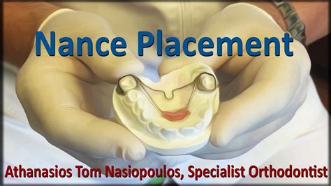 Nance Appliance Placement Athanasios Tom Nasiopoulos Youtube