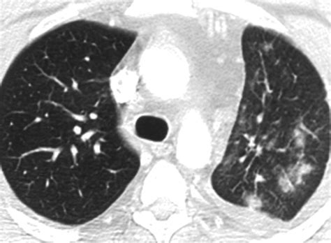 Pulmonary Venous Infarction After Radiofrequency Ablation For Atrial Fibrillation Ajr