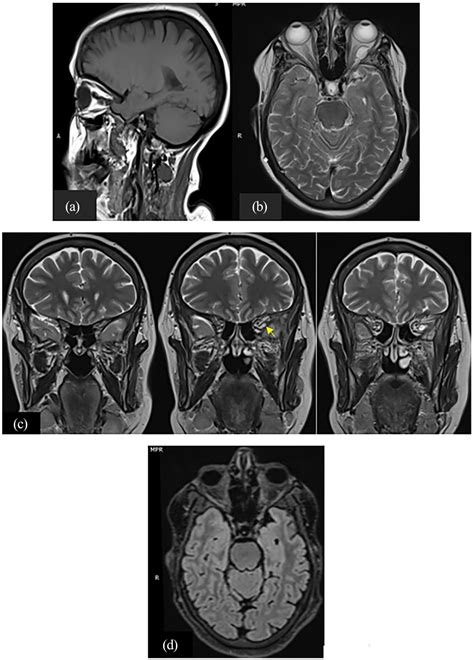 Arachnoid Cyst Mri