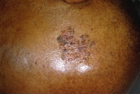 Skin Cancer Photo Gallery