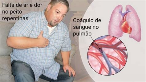 Os 9 Principais Sintomas de Embolia Pulmonar Dicas de Musculação