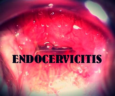 Endocervicitis Homeopathy Homoeopathic Drug Shots