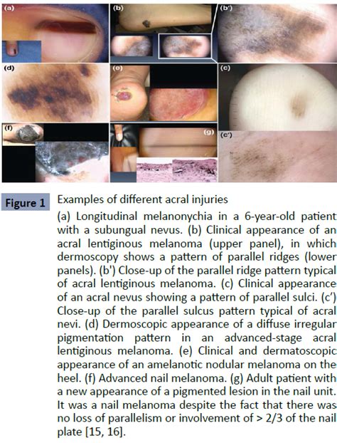 Relationship Between Acral Lentiginous Melanoma And Exposure To U