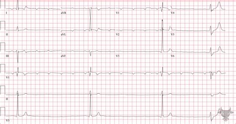 Third Degree Atrioventricular Block Ecg Stampede