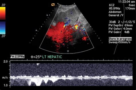 Understanding The Spectral Doppler Waveform Of The Hepatic Veins In