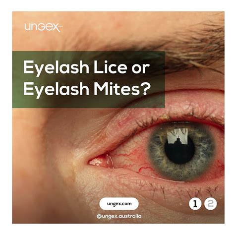 What Are Eyelash Lice Eyelashes Eyelash Mites Demodex Mites