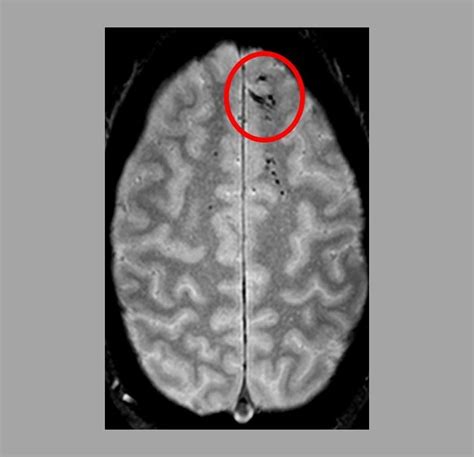 Microbleeds – Too Small to Be Detected on CT Scans – May Worsen Outcome ...