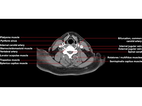 Ct Neck Axial Anatomy Radiologypicscom