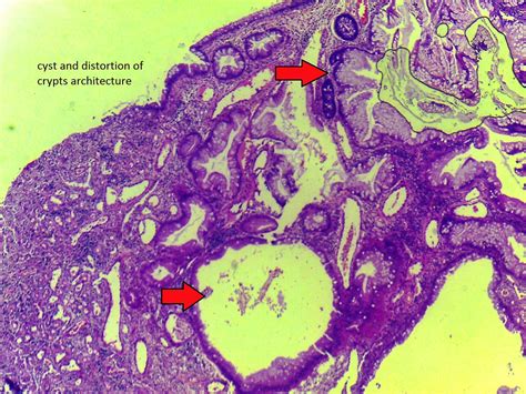 GASTROINTESTINAL AND LIVER HISTOLOGY PATHOLOGY ATLAS: COLON: JUVENILE POLYP