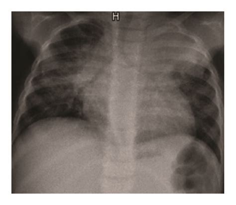 A Chest X Ray Bilateral Extensive Infiltrations Especially Prominent