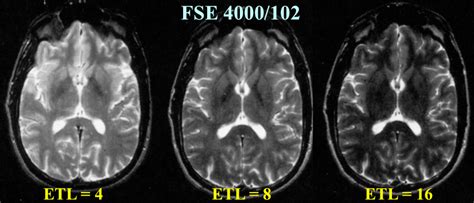 Fast Spin Echo FSE Questions And Answers In MRI