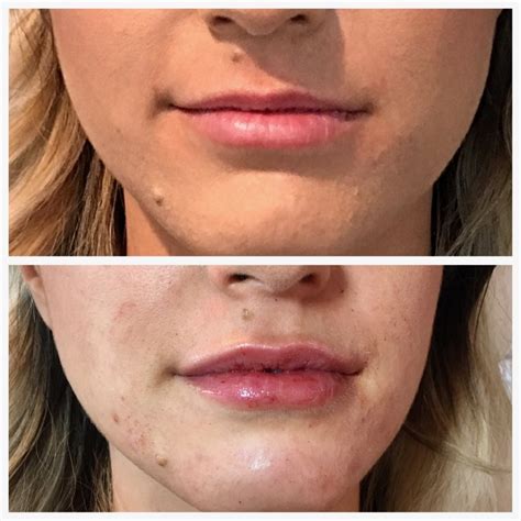 Lip Filler Nh Restylane And Juvéderm Lip Filler