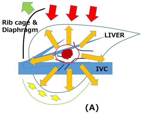 Laparoscopic Repeat Liver Resection—selecting The Best Approach For