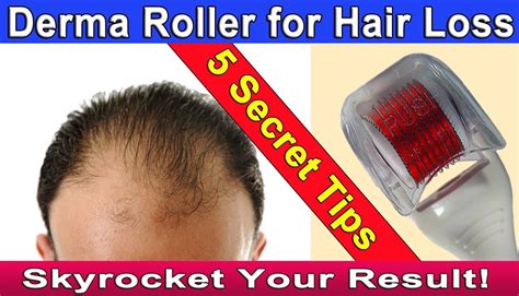 Microneedling Dermaroller For Hair Loss Or Hair Regrowth 5 Tips To Skyrocket Your Results