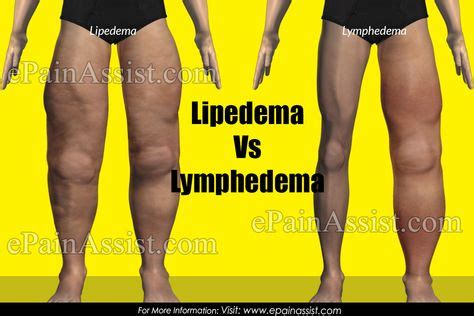 Lipedema Vs Lymphedema | Lymphedema, Lipedema, Tumescent liposuction