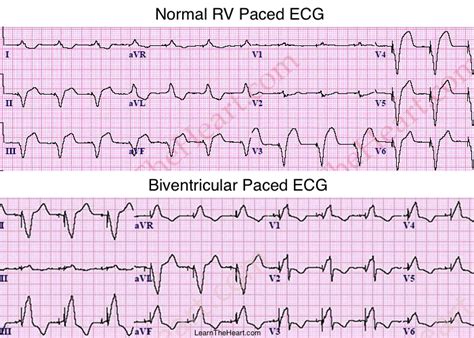 Biventricular Pacemaker