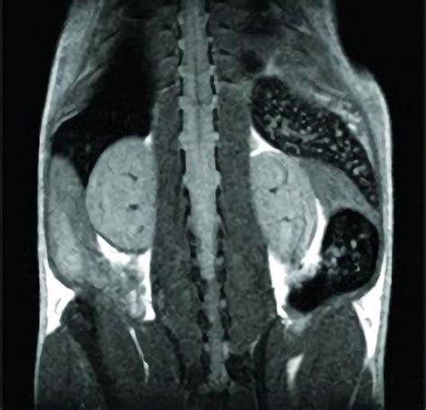 Nanoparticle Based MRI Technique Predicts Onset of Diabetes