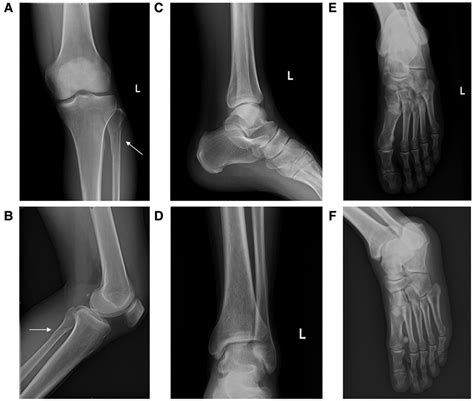 Frontiers Nonoperative Treatment Of Avulsion Fracture Of The Anterior Tibia With Proximal