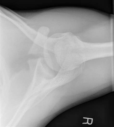 Coracoid Fracture In An Adolescent Rugby Player Case Report And Review Of The Literature