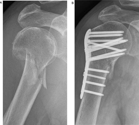 A Modified Deltoid Splitting Approach With Axillary Nerve Bundle