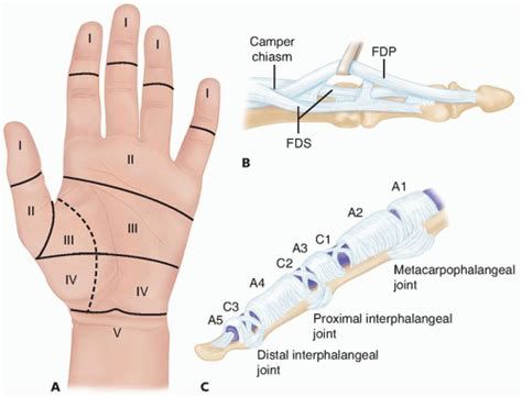 Flexor Tendon Laceration