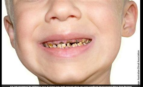 Imagens Chocantes Mostram Como O Açúcar Pode Destruir Os Dentes Das