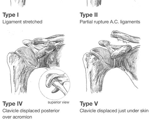 Figure 3 From Management Of Acromioclavicular Injuries Current