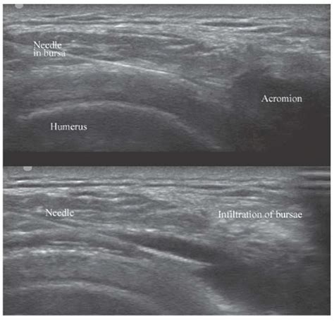 Ultrasound Guided Subacromial Bursa Injection Anesthesia Key