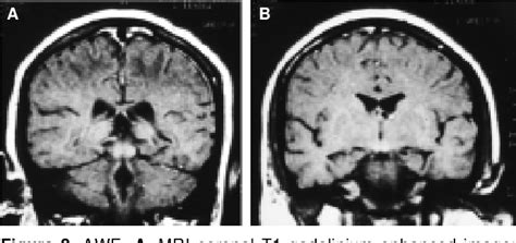 Figure From Acute Wernicke S Encephalopathy Comparison Among The