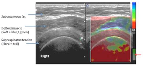 Figure 2 From The Value Of Sonoelastography In The Diagnosis Of