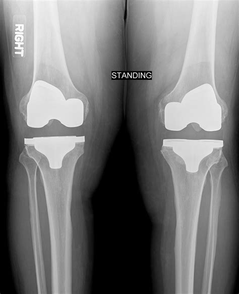 Simultaneous Versus Staged Bilateral Total Knee Arthroplasty | RheumNow