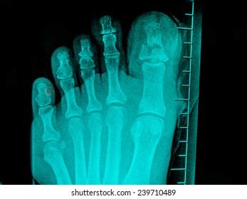 Film Xray Show Fracture Proximal Phalange Foto Stok