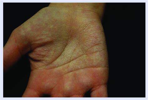 Aquagenic Keratoderma White To Translucent Papules On Edematous Palms