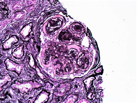 Pathology Outlines Diabetic Kidney Disease