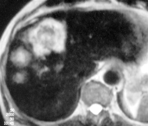 Ct And Mr Imaging Of Hepatic Metastases Ajr