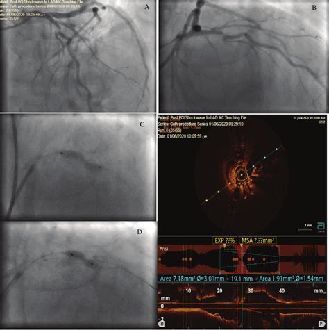 (A,B) Baseline angiographic views of LAD showing a severe proximal LAD ...