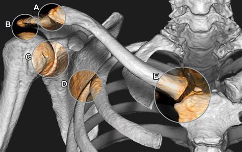 Imaging Of The Acromioclavicular Joint Anatomy Function Pathologic Features And Treatment