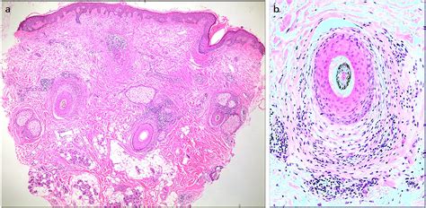 Scarring Alopecia Histology