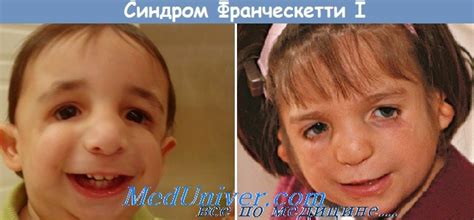Синдром Франческетти I (Franceschetti I) - синонимы, авторы, клиника