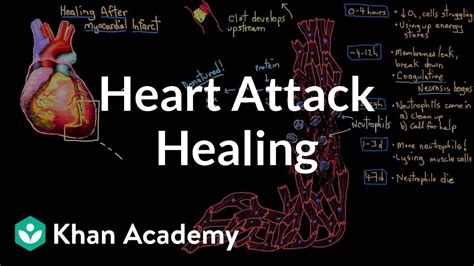 Healing After A Heart Attack Myocardial Infarction Nclex Rn Khan