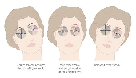 Cranial Nerve Palsies Knowledge Amboss Off