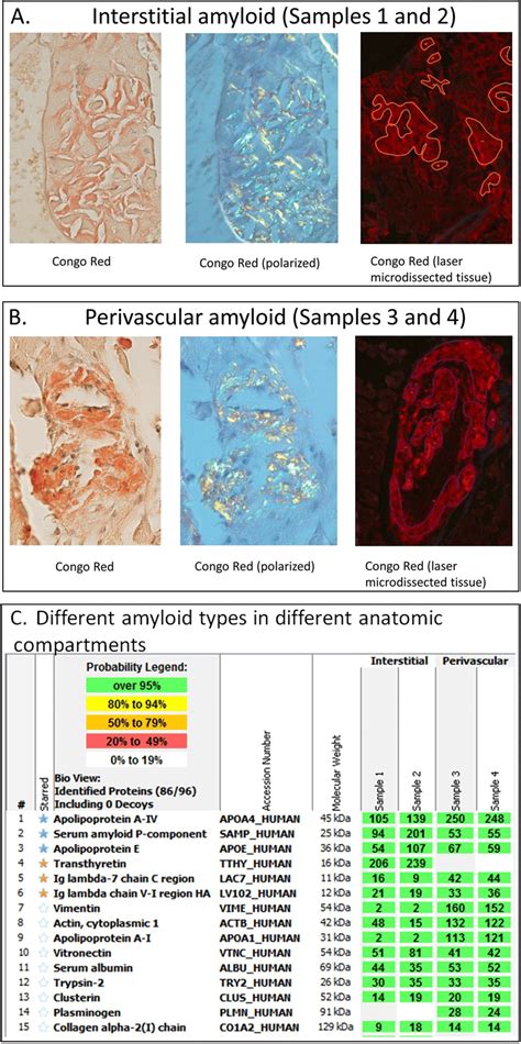 types  amyloid identified   anatomic compartments