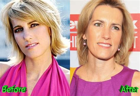 Laura Ingraham Before And After Plastic Surgery » Celebrity Plastic Surgery