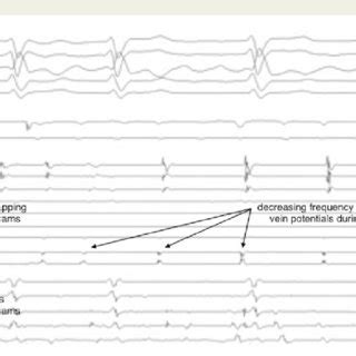 Periprocedural Recording Of Surface Electrocardiogram Leads II III