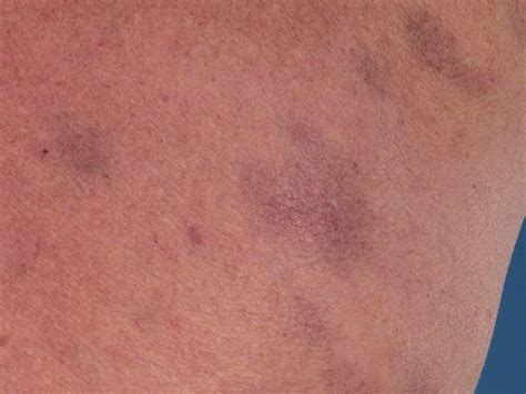 Erythema Dyschromicum Perstans Pictures Photos